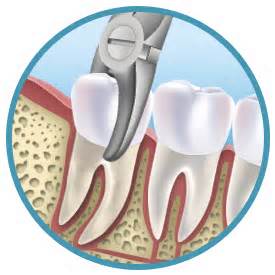 extractions