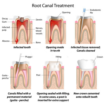 root canals