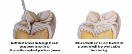 sealants