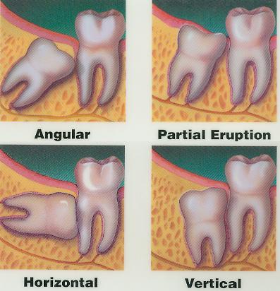 wisdom teeth